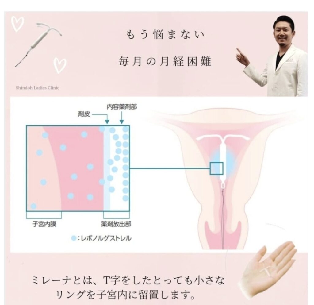 無痛「ミレーナ」!!