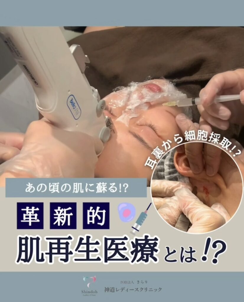 今予約が多い真皮線維芽細胞培養移植とは??✴️