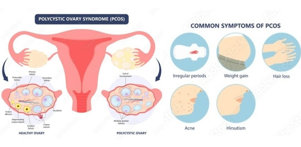 多嚢胞性卵巣症候群(PCOS)って何だろう?
