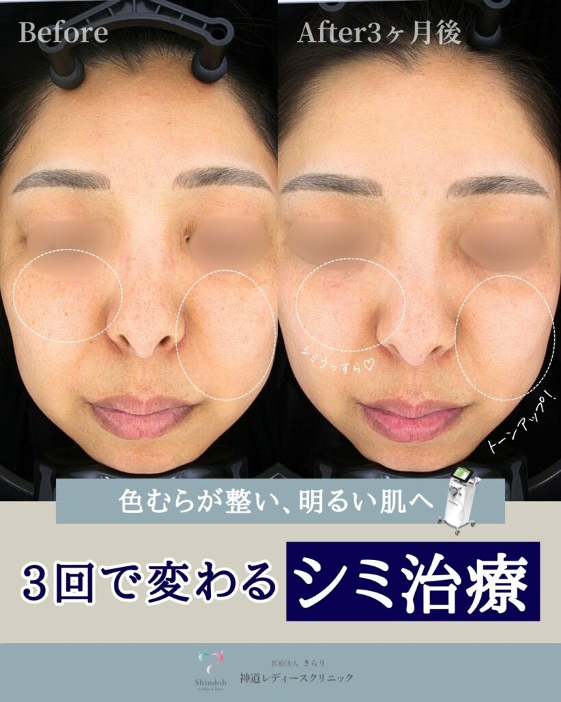 【大阪・門真・守口市】3回で変化するシミ治療|ルメッカ(IPL)の症例をご紹介