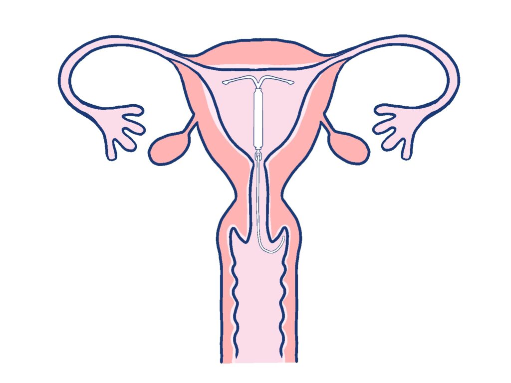 【大阪府門真市の産婦人科】ミレーナとは?生理痛・過多月経の治療と避妊|痛みが不安な方へ静脈麻酔も可能♪