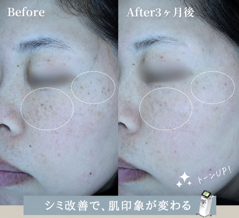 ルメッカ症例（Before/After 3ヶ月後）: シミ改善で、肌印象が変わる