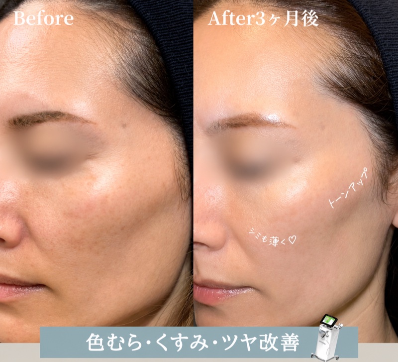 ルメッカ症例（Before/After 3ヶ月後）: 色むら・くすみ・ツヤ改善