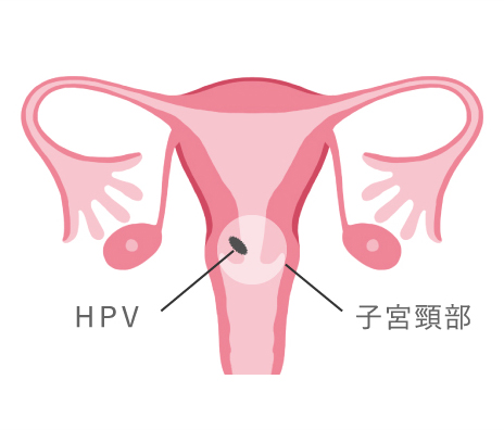 子宮頸部 HPV